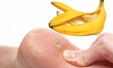 Skórka bananowa do leczenia brodawki podeszwowej