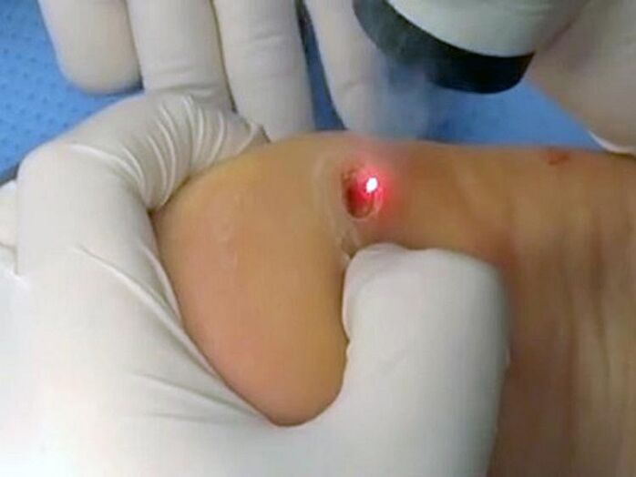 laserowe leczenie brodawek