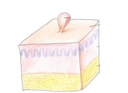 jak pozbyć się brodawczaka na ciele