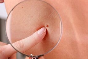 przyczyny pojawienia się brodawczaków na ciele ludzkim